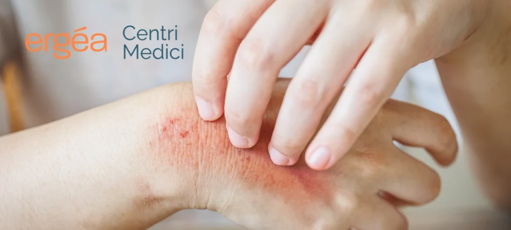 Differenze tra allergia alimentare e intolleranza alimentare