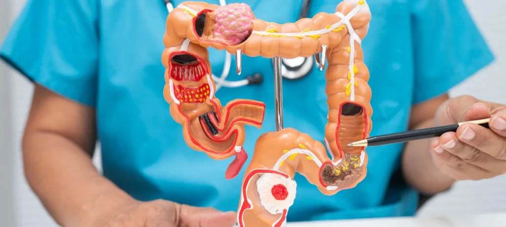 cos'è il colon-retto