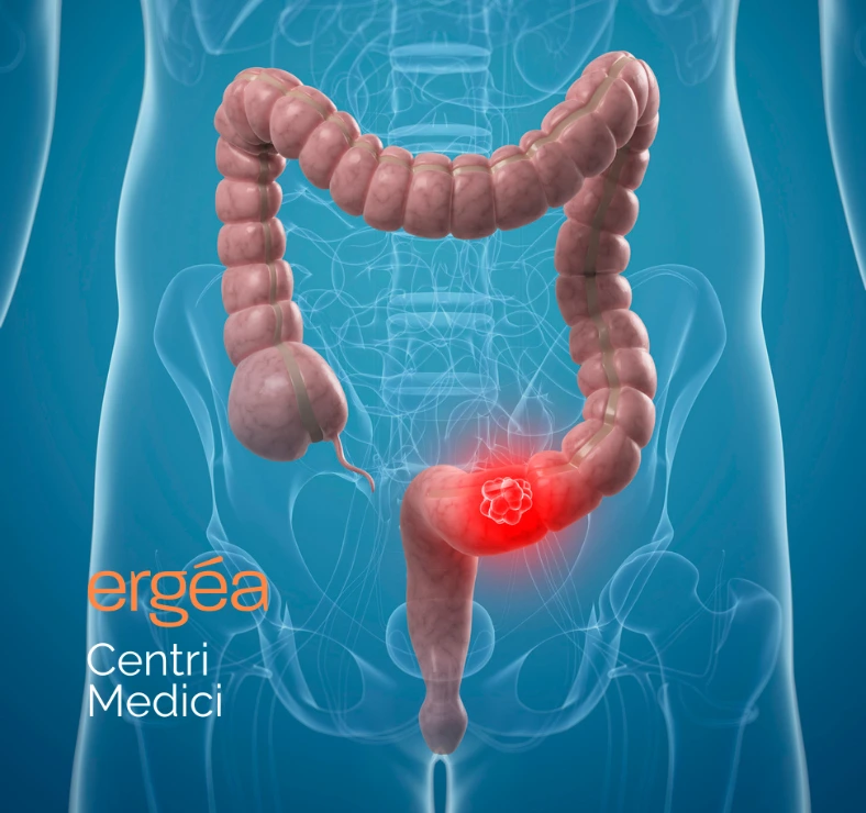 Cancro del colon-retto